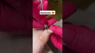 Pinky toe Callus removal relaxingmusic satisfying footcare [upl. by Relly488]