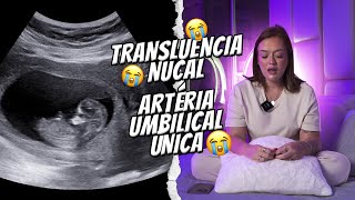 TRANSLUCENCIA NUCAL ALTERADA  ARTÉRIA UNICA UMBILICAL má formação [upl. by Gelasias]