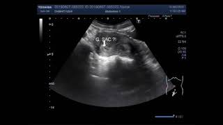 Ultrasound Video showing detection of early pregnancy with decidual reaction [upl. by Ennovihc]