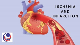 Ischemia and Infarction The difference and Similarities [upl. by Leonhard]