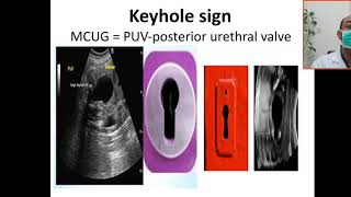 Case 188 posterior urethral valve obstructive uropathy keyhole sign in MCUG renal dysplasia VUR [upl. by Matthaus]