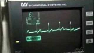 CBS News  Stress Test Vs Heart Scan [upl. by Lednik985]