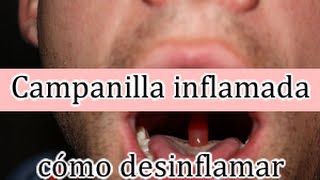 Campanilla inflamada tratamiento para desinflamar [upl. by Dannye]