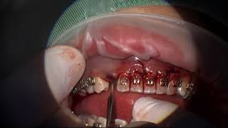 Autotransplantation impacted canine [upl. by Naraj499]