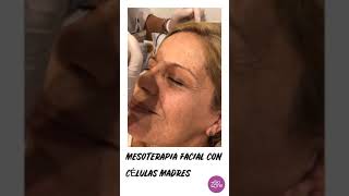 Mesoterapia Facial con Células Madres Entérate como lo hacemos en BioZone Belgrano Visítenos [upl. by Verger592]