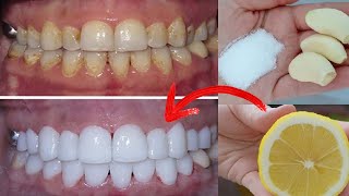 Teeth Whitening in Just 2 Minutes  Turn Yellowing and Tartar Buildup into Shiny Milky White [upl. by Alinna392]