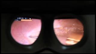 Head and Neck Cancer Robotic Surgery  Birmingham Ala [upl. by Sirenay948]