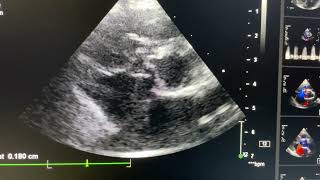 Isolated Gerbode defect [upl. by Kovacs400]