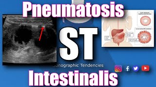 Pneumatosis Intestinalis [upl. by Neelahtak]