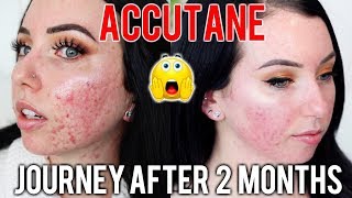 MY ACCUTANE JOURNEY 2 MONTH UPDATE Before amp After Side Effects Skin Care Products Im using [upl. by Yaffit]