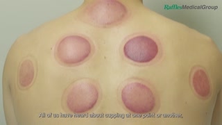 What You Need to Know about Cupping [upl. by Nadnal]