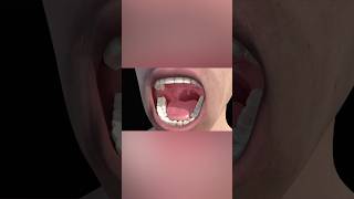 Tonsillitis medicalanimation health [upl. by Concha]