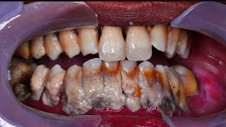 ScalingTeeth Cleaning  Should you get it done [upl. by Najib]