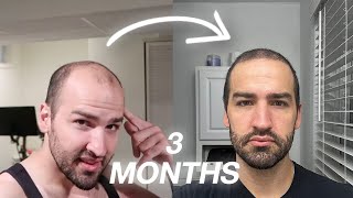 Hair Transplant Results  Now Hair Time  Update [upl. by Hannaj]