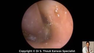 Top Biggest Ear Wax Removal 88  Ear wax Extraction  Dr S Thouk Earwax Specialist [upl. by Elocn]