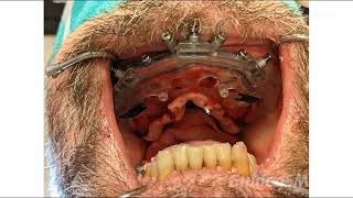 GuidedSMILE Dentate Maxilla Nobel FP3  Dr Fried [upl. by Itak]