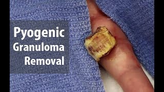 What are you holding Lets cut it off  Enormous Pyogenic Granuloma Removal  Dr Derm [upl. by Aray270]