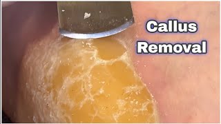 Foot Care  callus Removing callusremoval diyasrmfyptrendingvideotrendingshorts [upl. by Dyoll]