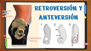 ✅RETROVERSIÓN Y ANTEVERSIÓN PÉLVICA ¿Qué es fácil [upl. by Enra]