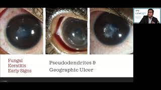 Lecture Microbial Keratitis Update for General Ophthalmologists [upl. by Ahsuatan]