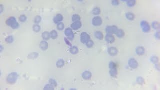 Malaria parasite plasmodium falciperum gametocyte in thick and thin blood smear in microscopic slide [upl. by Atwahs]