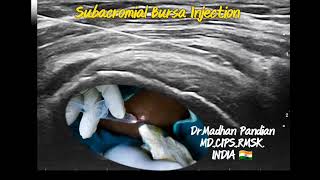 Subacromial bursa injection [upl. by Niarda349]