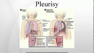 Pleurisy [upl. by Fransis]