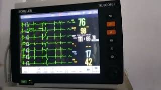 case of Ventricular Bigeminy changing to Trigeminy and Quadrigeminy [upl. by Eskil]