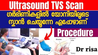 Ultrasound TVS Scan MalayalamPregnancy ScanWhen to Do TVS [upl. by Airdnaed292]