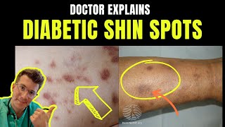 Doctor explains DIABETIC DERMOPATHY AKA DIABETIC SHIN SPOTS – plus causes and prevention [upl. by Eigroeg]