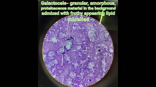 Cytologygalactocelebenign breast disease pathologymedical [upl. by Nerrual410]