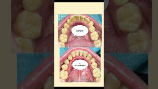 Scaling amp Polishing of Teeth [upl. by Tnirb]