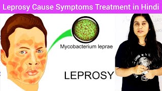 Leprosy Cause Symptoms Treatment Prevention in Hindi  Leprosy In Hindi  LeprosyHansens disease [upl. by Tonry353]