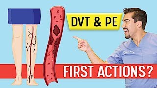 DVT Animation Deep Vein Thrombosis and Pulmonary Embolism PE Memory Tricks for Exams NCLEX [upl. by Jessica563]