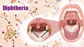 Diphtheria  Introduction of diphtheria  Definition of diphtheria  causes of diphtheria💯✨ [upl. by Opaline]