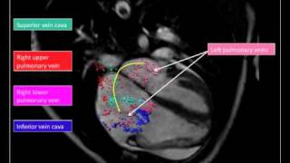 4D PhaseContrast Flow Cardiovascular Magnetic Resonance Comprehensive Quantification and Visualiz [upl. by Johnsson]