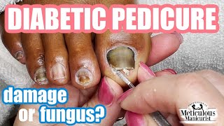 Diabetic Pedicure Toenail Damage or Nail Fungus [upl. by Reeva307]