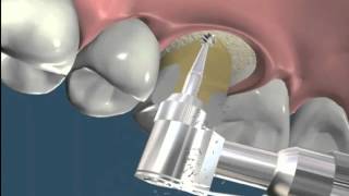 Alargamiento coronario por diente fracturado  Odontología Restauradora [upl. by Hadleigh943]