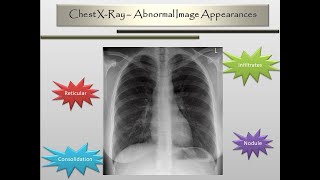 Chest XRay Abnormal Image Appearances [upl. by Varipapa421]