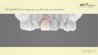 BioHPP SKY elegance  individuelle CrownAbutments Workflow German [upl. by Feinleib]