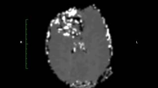 Mri Brain Perfusion Routine perfusion [upl. by Nhguav]