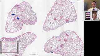 Pulmonary VenoOcclusive Disease PVOD  Deep Dives in Pulmonary Pathology [upl. by Fried]