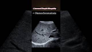 Hemochromatosis leading to Coarse Liver ❤️💯 HealthAwareness LiverHealth medical ultrasound [upl. by Gery]