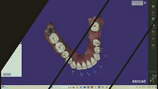 Exocad ortho orthodontics modules [upl. by Oneg]