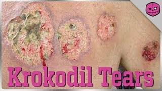 KROKODIL The FleshEating Russian Street Drug [upl. by Cantu987]