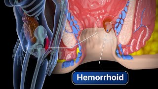 Hemorrhoid Removal  Step by step [upl. by Amleht]