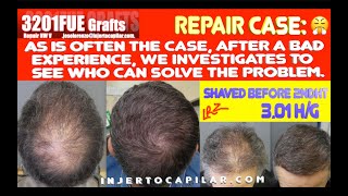 3201Grafts Repair NW V Shaved before 2nd HT White 30 hairsgraft Injertocapilarcom 29452023 [upl. by Diehl645]