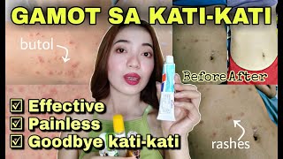 MABISANG GAMOT SA KATI KATI NG BALAT o KATAWAN  Rashes Pantal Butol Buni Insect bites amp Skinallergy [upl. by Ellery]