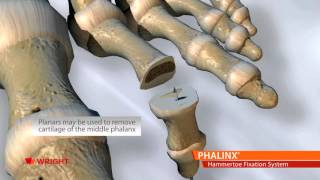 PHALINX™ Hammertoe Fixation System [upl. by Leahciam907]