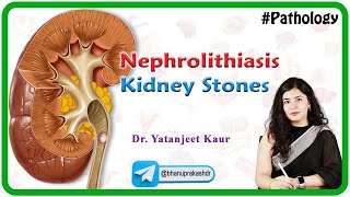 Nephrolithiasis  Kidney stones  Types Clinical features Diagnosis and Treatment Hindi [upl. by Lancelle587]